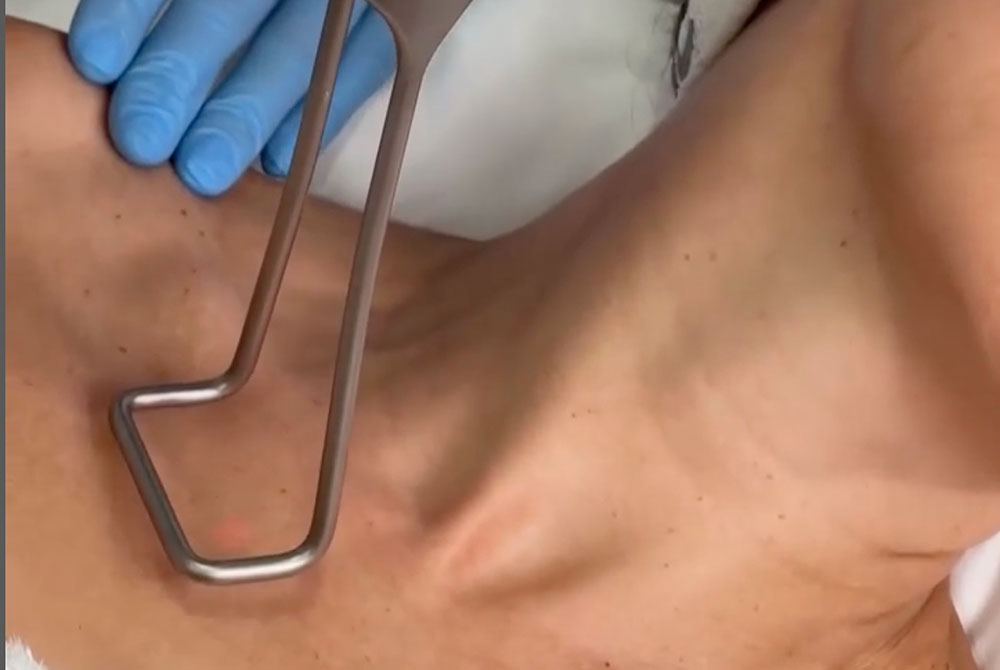 Tratamientos para rejuvenecer cuello y escote no quirúrgicos