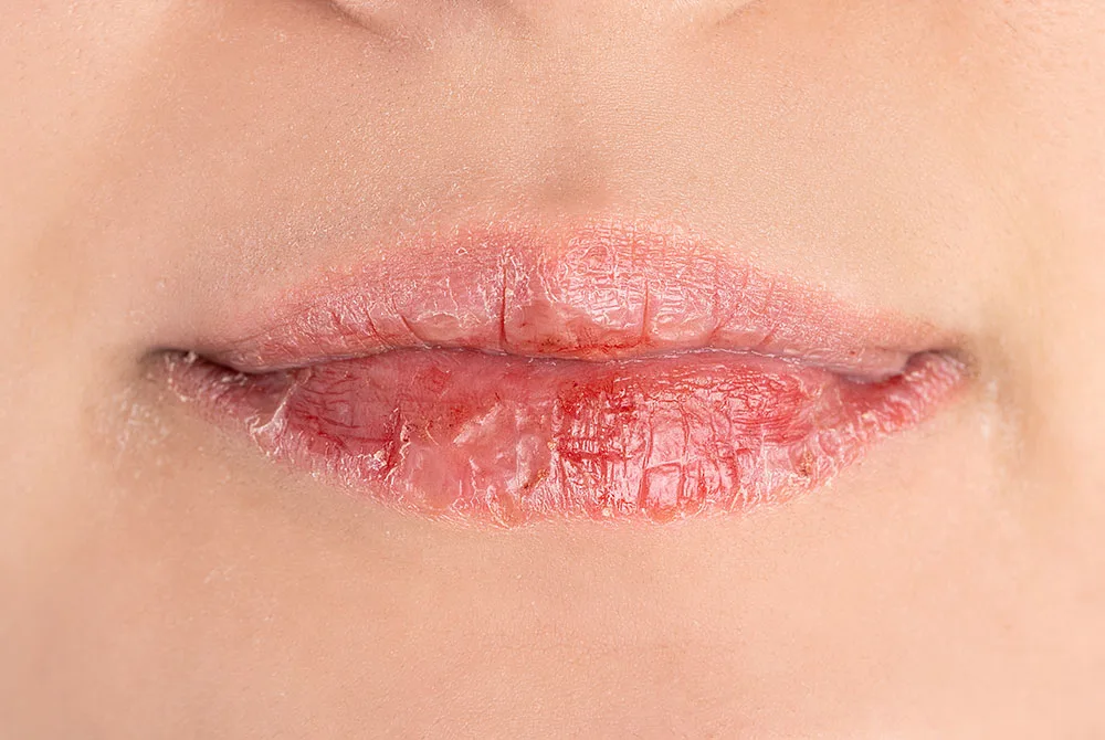Hidratación de labios los mejores tratamientos Hidratación de labios los mejores tratamientos