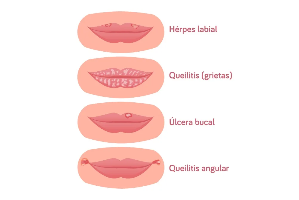 Hidratación de labios Hidratación de labios