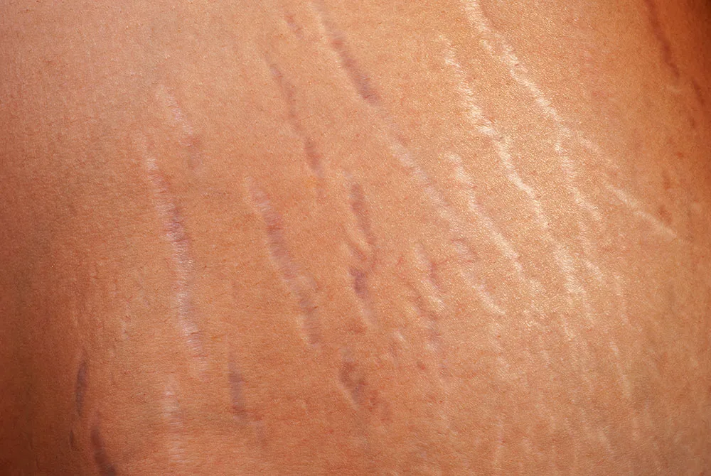 blog-carmen-s¿Como quitar las estrias?armiento-estrias-01 ¿Como quitar las estrias?