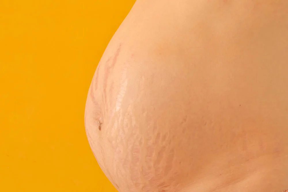 ¿Como quitar las estrias? ¿Como quitar las estrias?