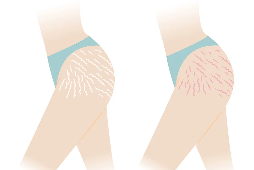 ¿¿Como quitar las estrias? ¿Como quitar las estrias?