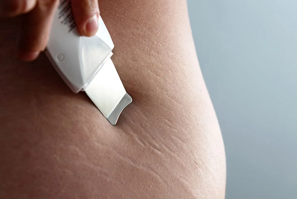 ¿Como quitar las estrias? ¿Como quitar las estrias?