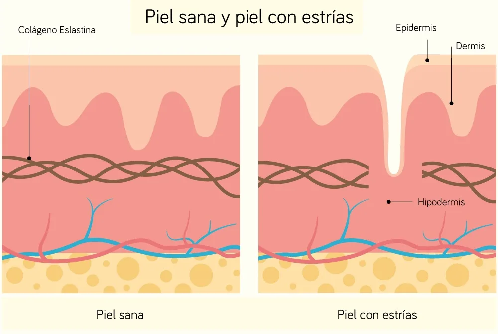 ¿Como quitar las estrias? ¿Como quitar las estrias?
