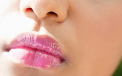 Aumento de labios con ácido hialurónico
