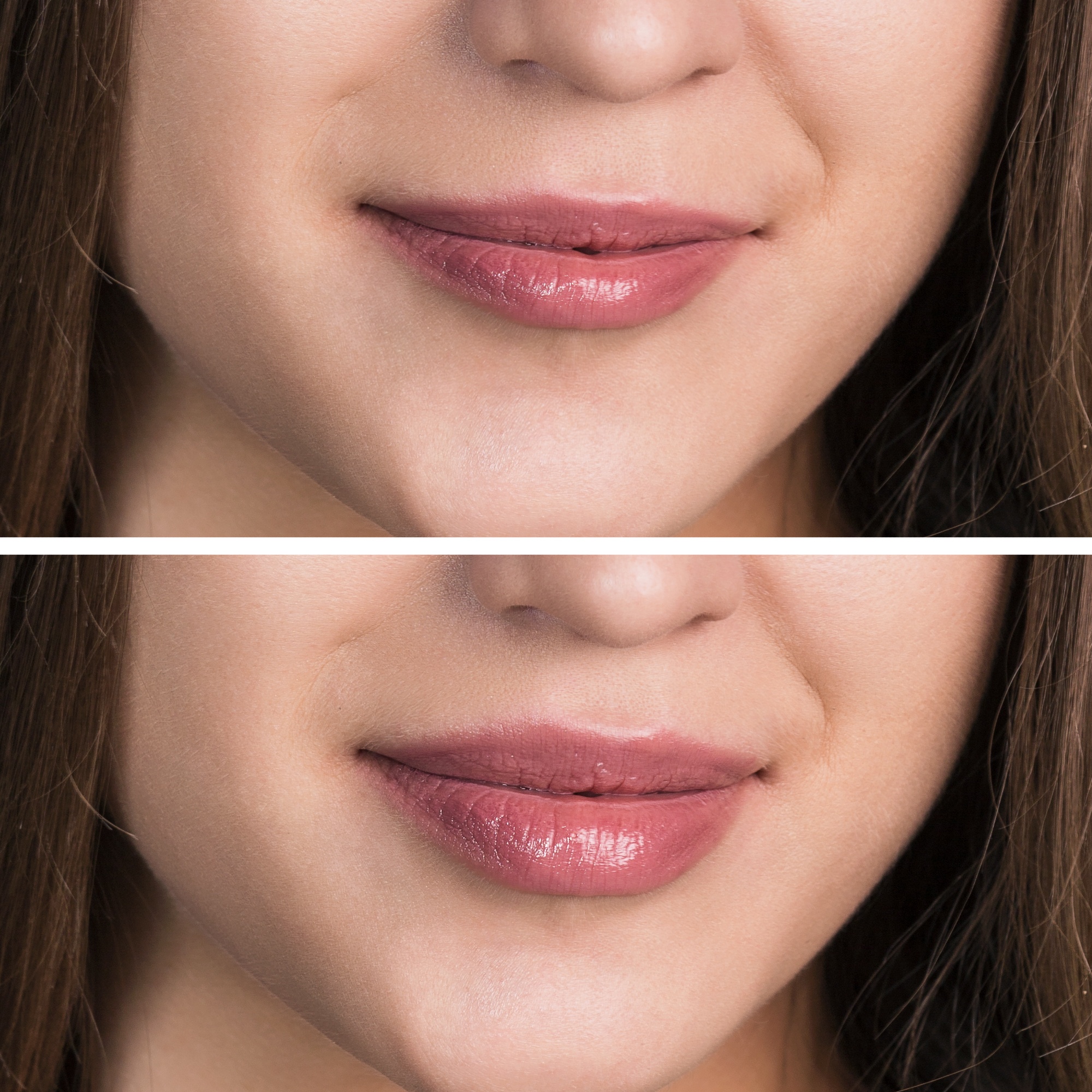 Aumento de labios con ácido hialurónico en Carmen Sarmiento