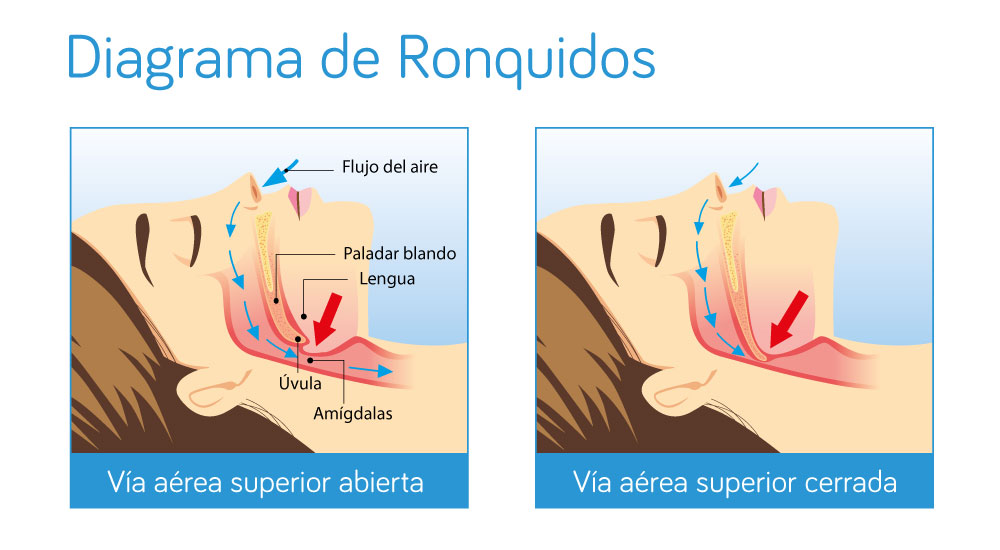 Tratamiento de los ronquidos con NightLase