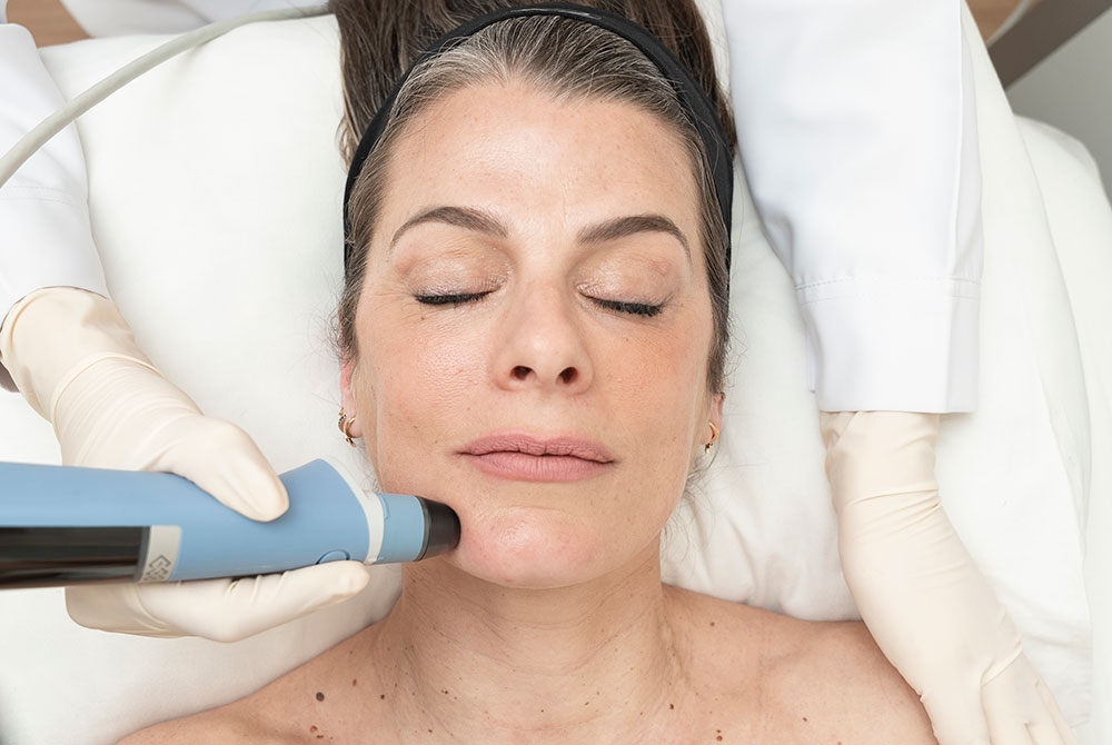 Lifting facial sin cirugía