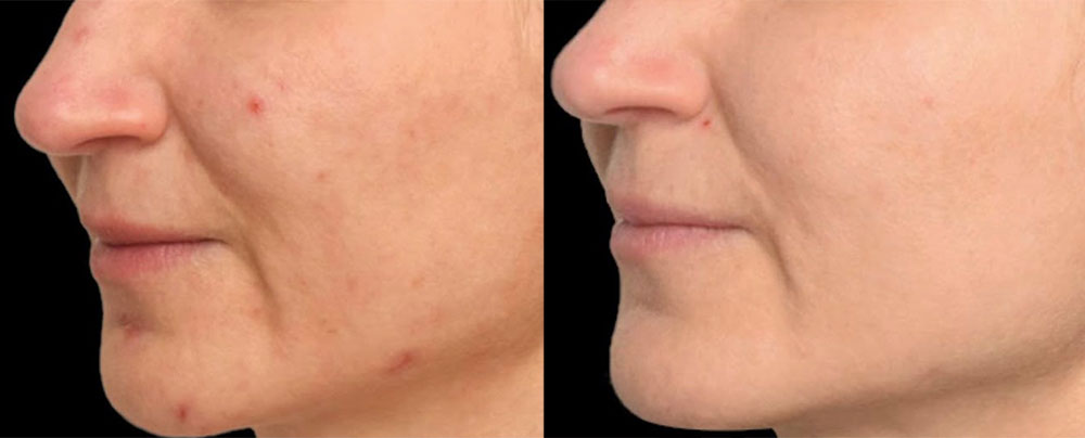 Lifting facial sin cirugía