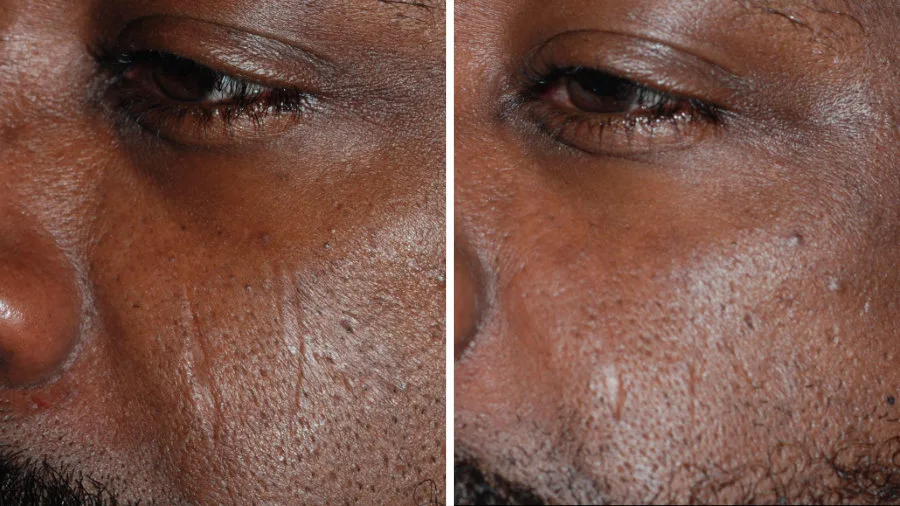 Antes y después de Láser Frío Ultraclear en Carmen Sarmiento. Revolución en Rejuvenecimiento Facial.