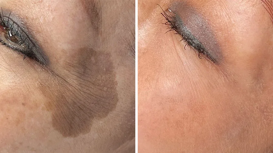 Láser Frío Ultraclear. Revolución en Rejuvenecimiento Facial.