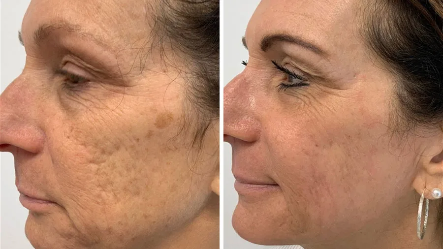 Láser Frío Ultraclear. Revolución en Rejuvenecimiento Facial.