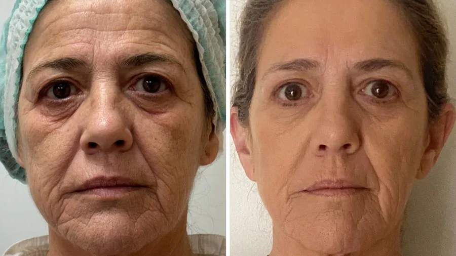 Antes y después de Láser Frío Ultraclear en Carmen Sarmiento. Revolución en Rejuvenecimiento Facial.