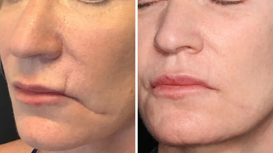 Antes y después de Láser Frío Ultraclear en Carmen Sarmiento. Revolución en Rejuvenecimiento Facial.