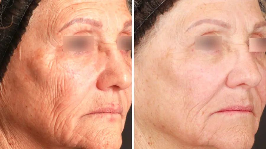 Antes y después de Láser Frío Ultraclear en Carmen Sarmiento. Revolución en Rejuvenecimiento Facial.
