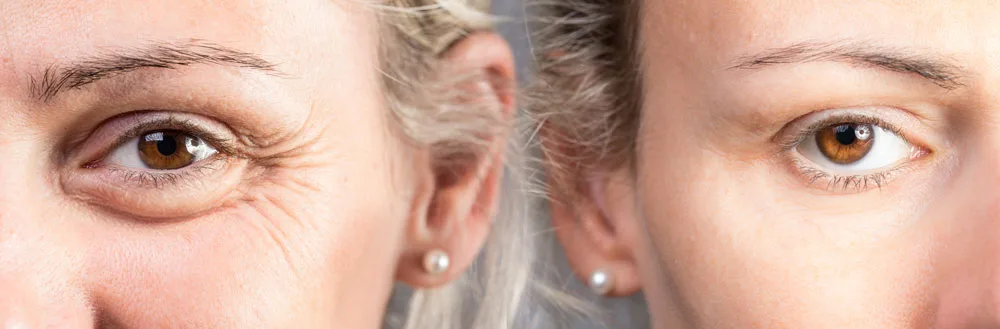 blog-centros-carmen-sarmiento-patas-de-gallo-03 Patas de gallo tratamientos con mejores resultados