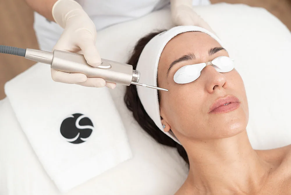 blog-centros-carmen-sarmiento-patas-de-gallo-06 Patas de gallo tratamientos con mejores resultados