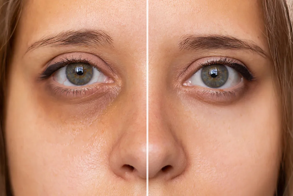 Antes y después de un tratamiento de ojeras hundidas las ojeras hundidas