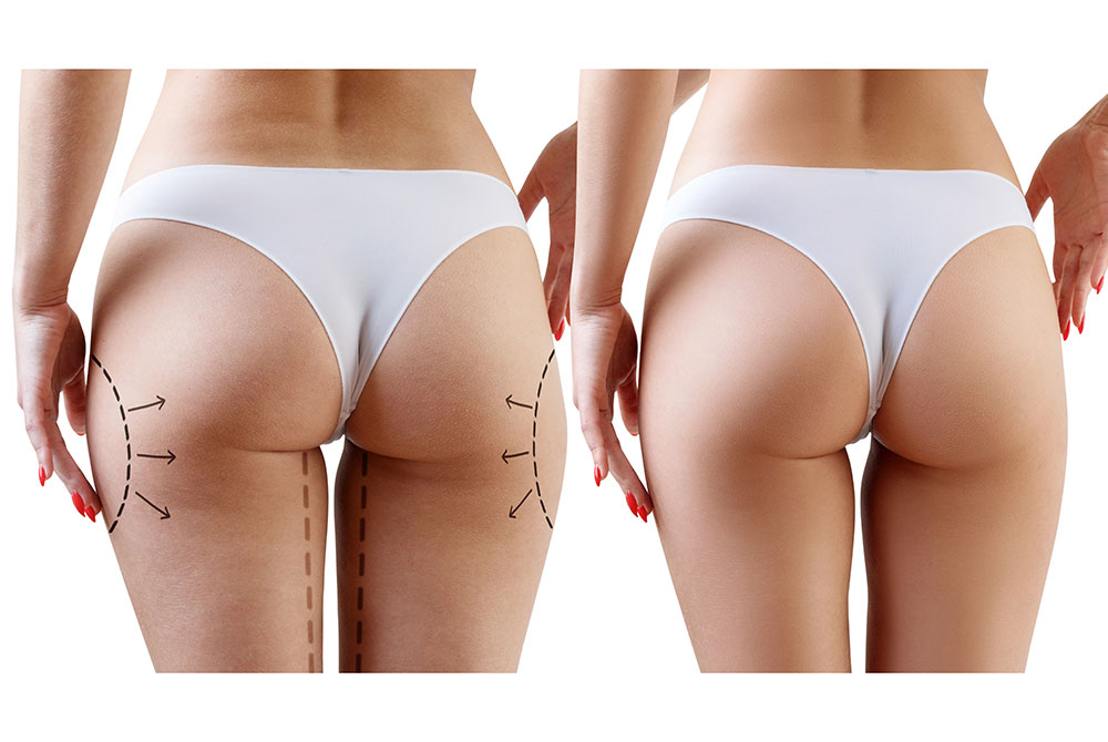 El secreto para eliminar las cartucheras en la mujer El secreto para eliminar las cartucheras en la mujer