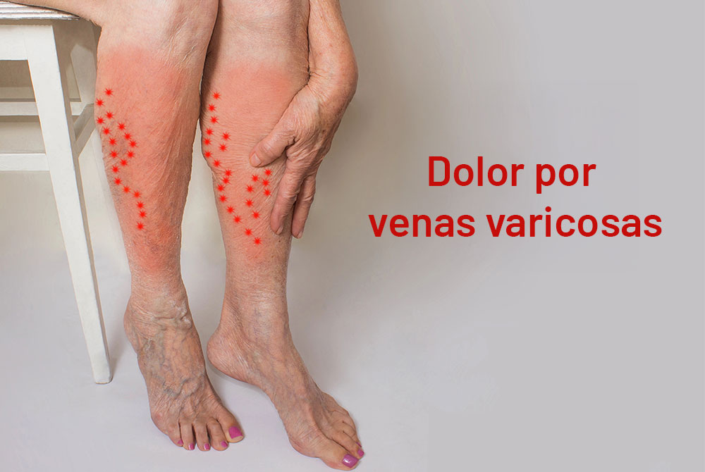 blog-carmen-sarmiento-tipos-varices-01 Tipos de varices cómo tratarlas de forma eficaz