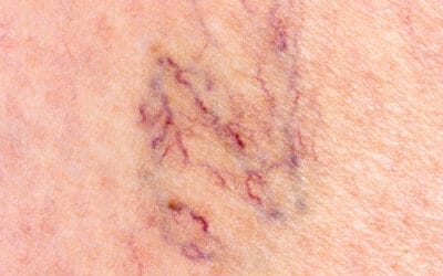 Tipos de varices cómo tratarlas de forma eficaz