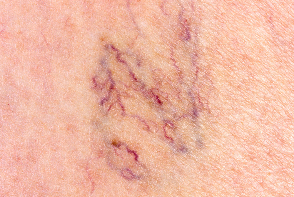 blog-carmen-sarmiento-tipos-varices-02 Tipos de varices cómo tratarlas de forma eficaz