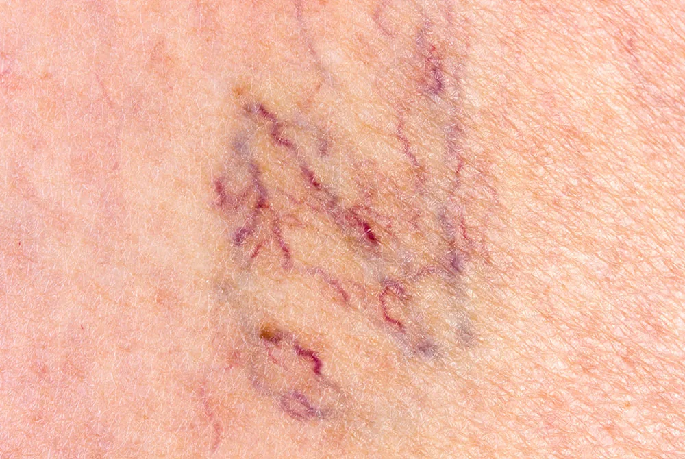 Tipos de varices cómo tratarlas de forma eficaz