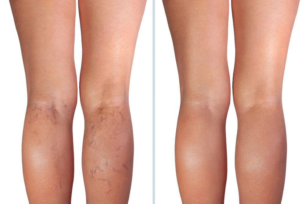 blog-carmen-sarmiento-tipos-varices-03 Tipos de varices cómo tratarlas de forma eficaz