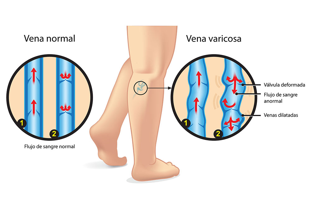 blog-carmen-sarmiento-tipos-varices-04 Tipos de varices cómo tratarlas de forma eficaz