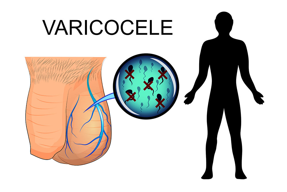 blog-carmen-sarmiento-tipos-varices-08 Tipos de varices cómo tratarlas de forma eficaz