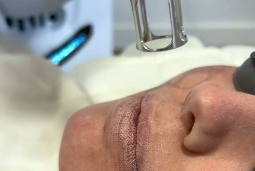 blog-carmen-sarmiento-laser-facial-03 Laser facial, descubre nuestros tratamientos láser en Carmen Sarmiento