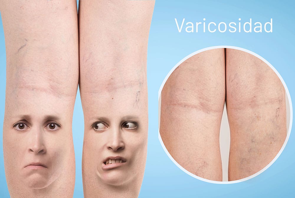 Elimina las arañas vasculares de forma eficaz y rápida