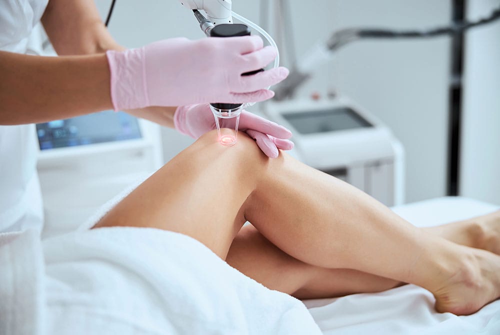 Elimina las arañas vasculares de forma eficaz y rápida