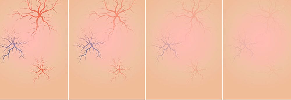 Elimina las arañas vasculares de forma eficaz y rápida