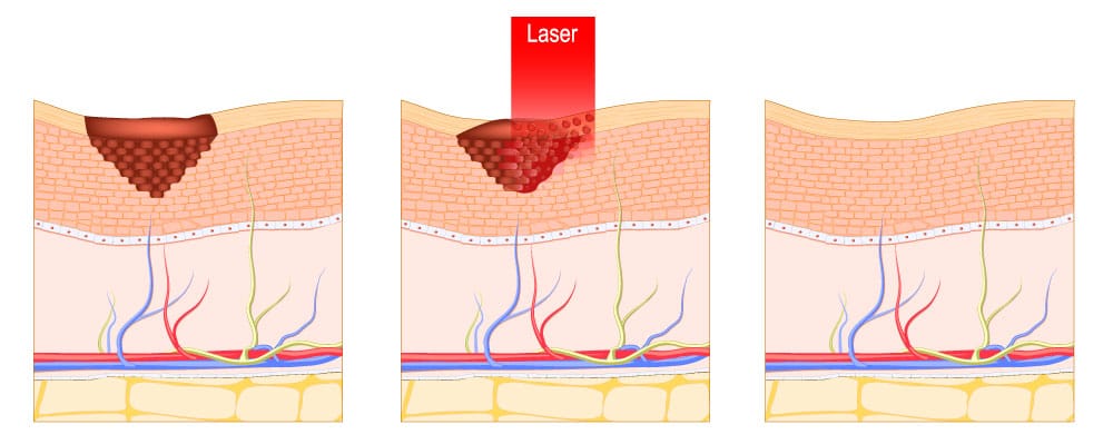 Laser facial, descubre nuestros tratamientos láser en Carmen Sarmiento Laser facial, descubre nuestros tratamientos láser en Carmen Sarmiento