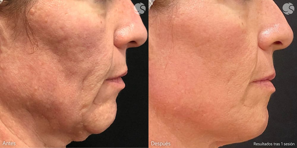 Laser facial, descubre nuestros tratamientos láser en Carmen Sarmiento Laser facial, descubre nuestros tratamientos láser en Carmen Sarmiento