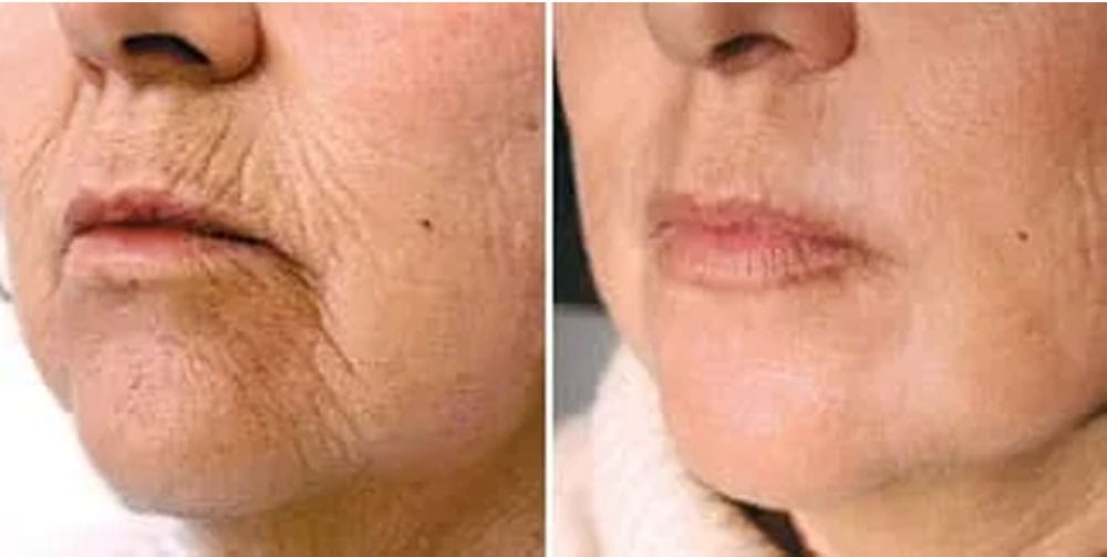 Laser facial, descubre nuestros tratamientos láser en Carmen Sarmiento Laser facial, descubre nuestros tratamientos láser facial en Carmen Sarmiento