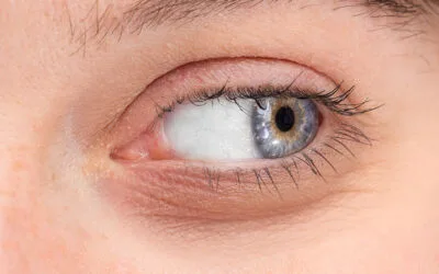 Carmen Sarmiento. Centro de Medicina Estética 11 Tratamientos para ojeras eficaces y con resultados visibles