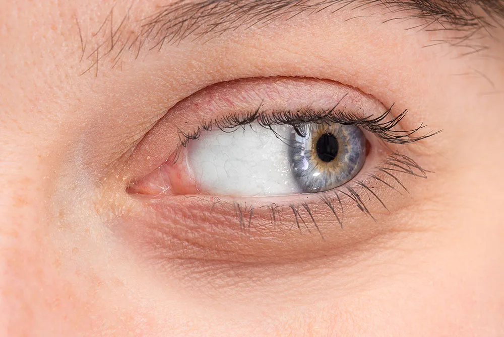 Tratamientos para ojeras eficaces y con resultados visibles