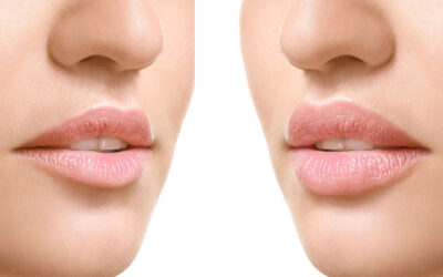 Aumento de labios los mejores tratamientos no quirúrgicos