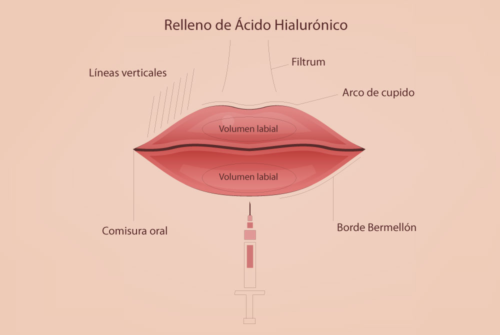 Aumento de labios los mejores tratamientos no quirúrgicos