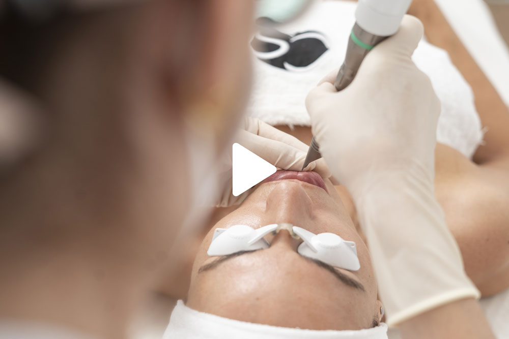 blog-centros-carmen-sarmiento-aumento-de-labios-04 Aumento de labios los mejores tratamientos no quirúrgicos