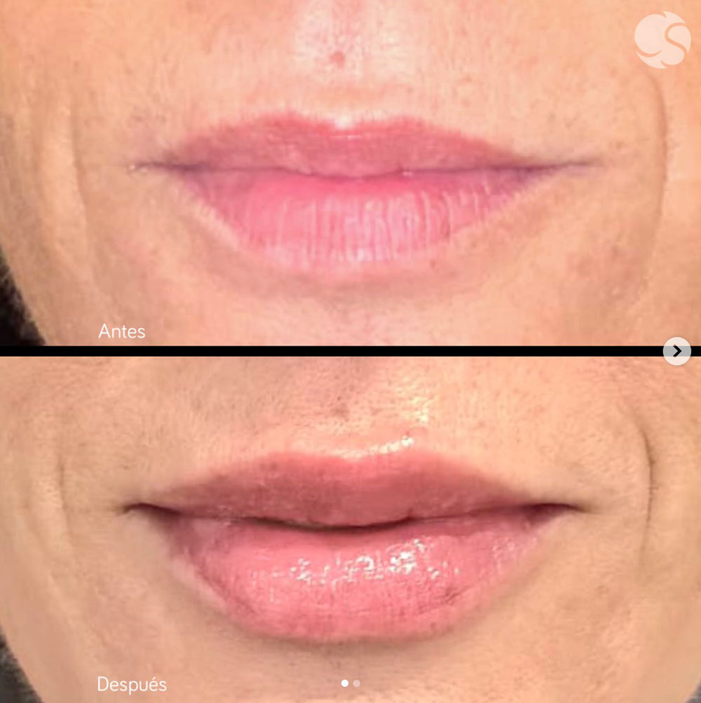 Aumento de labios los mejores tratamientos no quirúrgicos