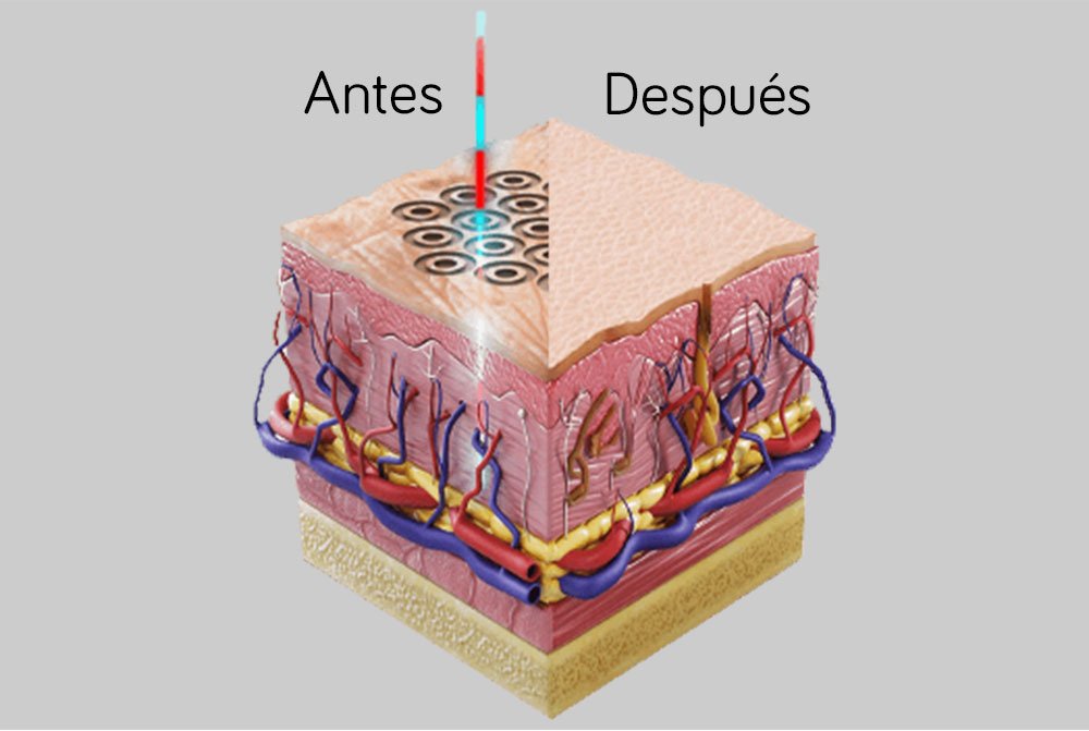 Como actúa el láser frío sobre la piel Láser frío el rejuvenecimiento facial más innovador
