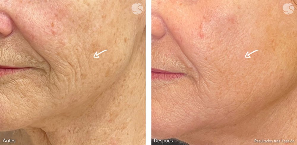 blog-centros-carmen-sarmiento-laser-frio-03 Láser frío el rejuvenecimiento facial más innovador