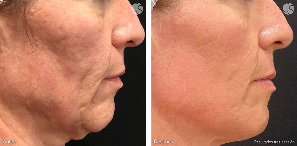 blog-centros-carmen-sarmiento-laser-frio-04 Láser frío el rejuvenecimiento facial más innovador