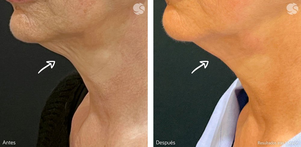 blog-centros-carmen-sarmiento-laser-frio-05 Láser frío el rejuvenecimiento facial más innovador