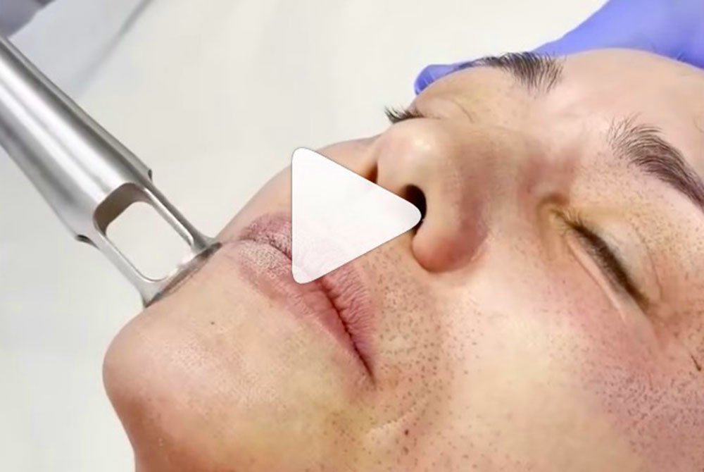 blog-centros-carmen-sarmiento-laser-frio-06 Láser frío el rejuvenecimiento facial más innovador