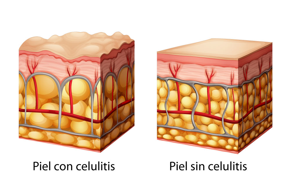 Piel de naranja tratamientos novedosos que funcionan