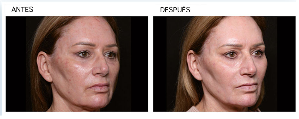 Imagen antes y después de tratamiento estético con radiofrecuencia facial Tratamientos con radiofrecuencia para medicina estética